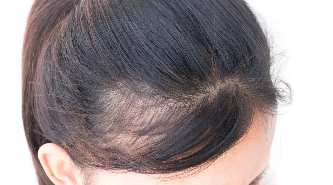 Alopecia in women