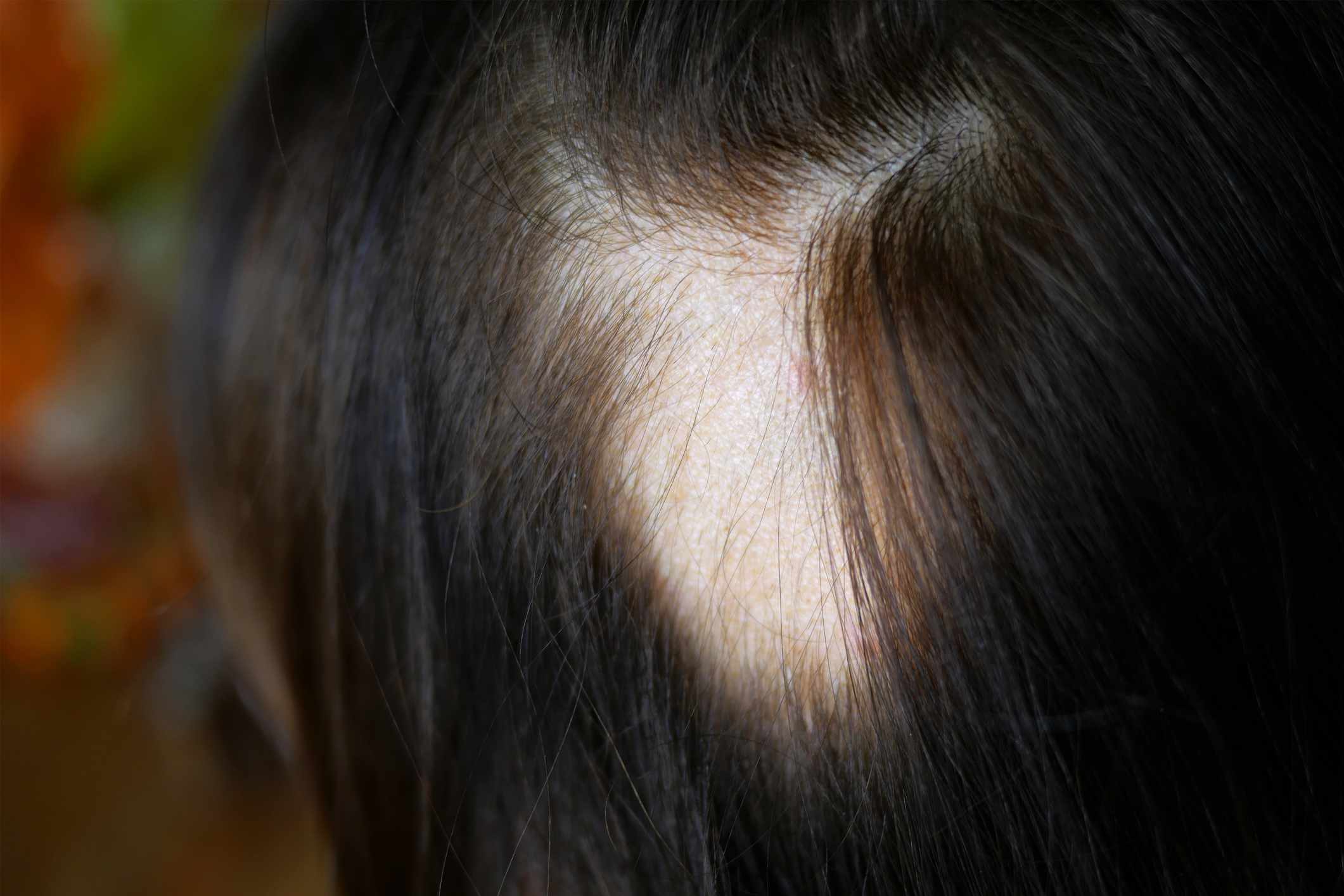 Alopecia in women