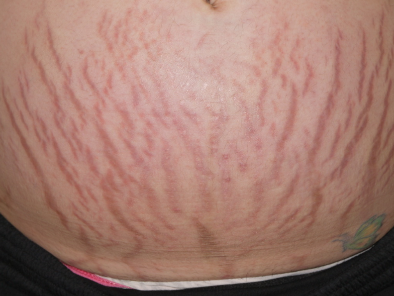 Stretch Marks Treatment Cost