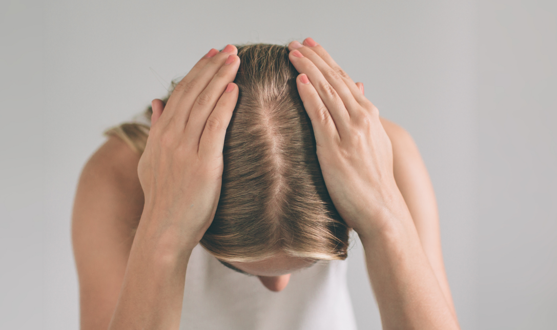 alopecia in women